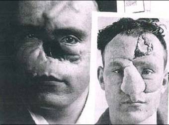 The World’s First Plastic Surgery Was Miraculous, But It Looked Pretty Gruesome.