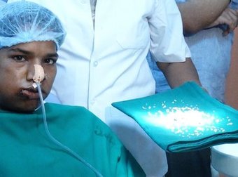 Shark Mouth! This Indian Teen Had 232 Extra Teeth Removed From His Mouth.