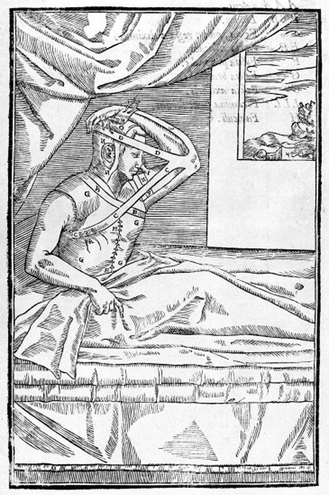 Tagliacozzi became famous for his unique surgical methods. Instead of cutting a piece of skin off of the forehead and attaching it to the nose (as was common at the time), Tagliacozzi did something counterintuitive.