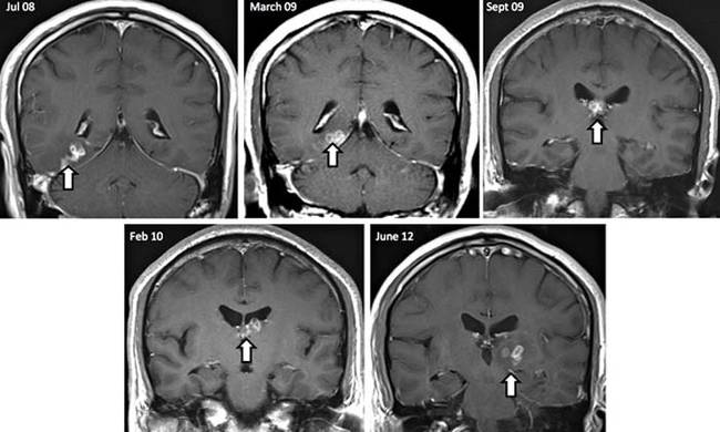 You can see the worm here making its way around the man's brain. Doctors speculate that the worm, rather than eating the man's brain, absorbed nutrients from the brain directly through its body (since it has no mouth).