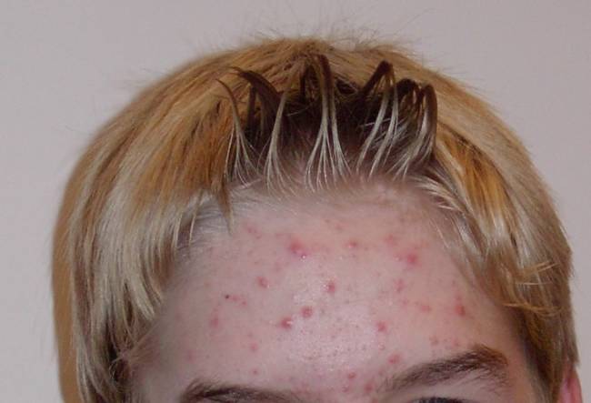 Acne is a skin condition when white and black heads are constantly present on a person's skin. Many experience acne as teenagers during puberty, but some can experience acne in adulthood as well.