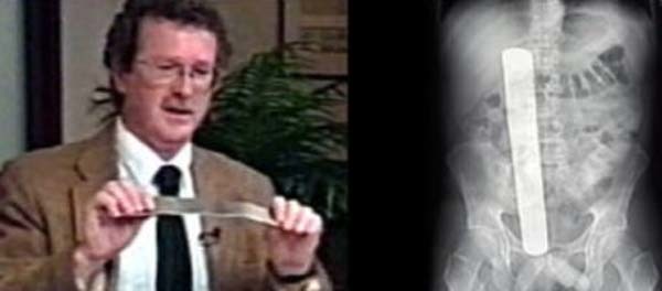 4.) Donald Church was having a tumor removed from his abdomen at the University of Washington Medical Center in Seattle in June 2000. After recovering and leaving, he discovered that doctors left a 13 inch-long retractor in his abdomen by mistake.