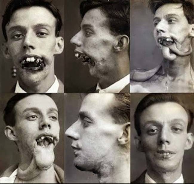 Following the end of the second World War Gillies ran a private practice and trained many doctors in the techniques of plastic surgery.