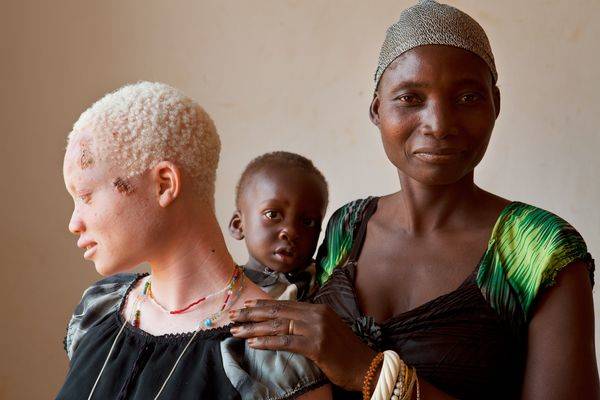 To the Tanzanians, albinos are seen as cursed beings. In the past, families were encouraged to kill their albino young as swiftly as possible.