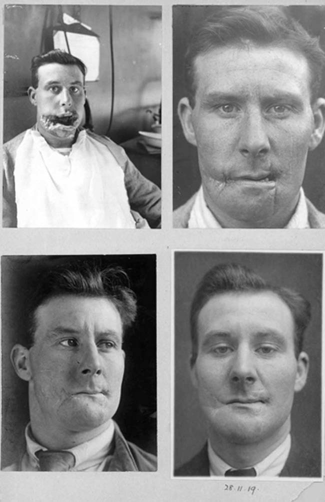 Over the following years Gillies and his colleagues developed the practice of modern day plastic surgery. They performed over 11,000 surgeries on about 5,000 soldiers who were disfigured during the war.