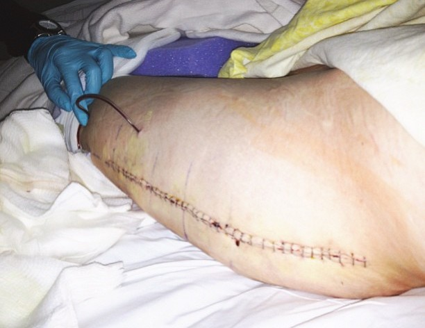 A massive scar from a surgery.