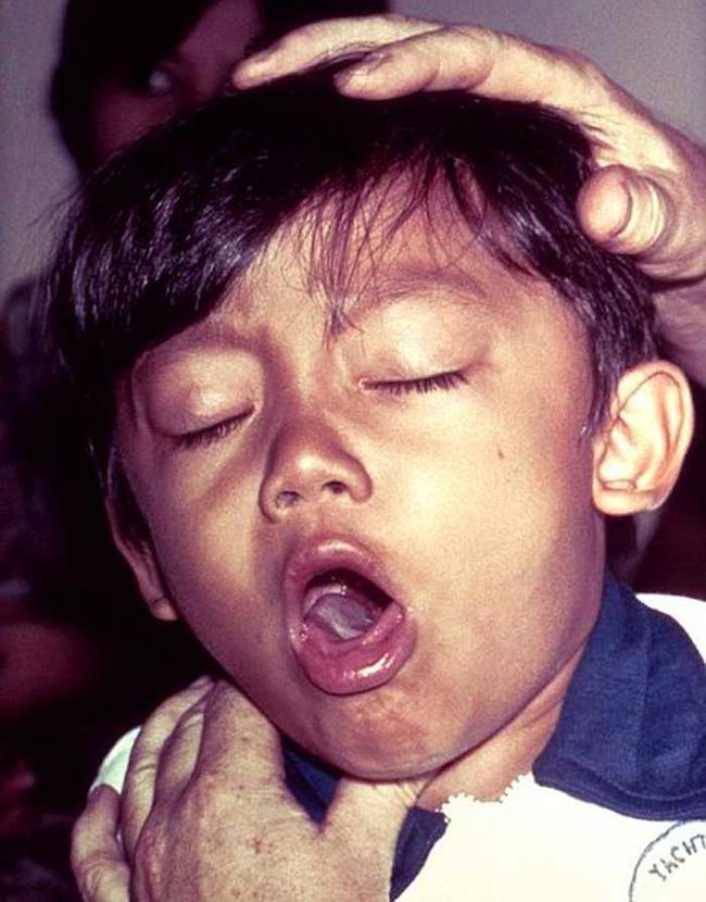 1.) Whooping Cough.