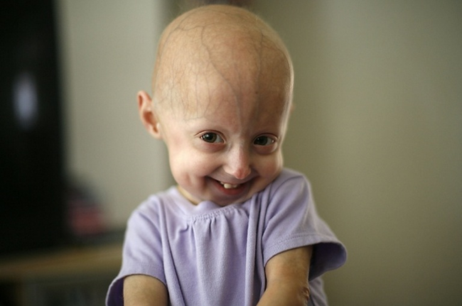 3.) Progeria Syndrome: This syndrome has similar symptoms to one growing old with age—loss of hair, wrinkles—except for they occur in young children.