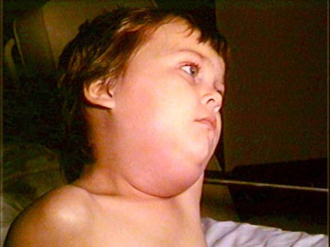 5.) Mumps.