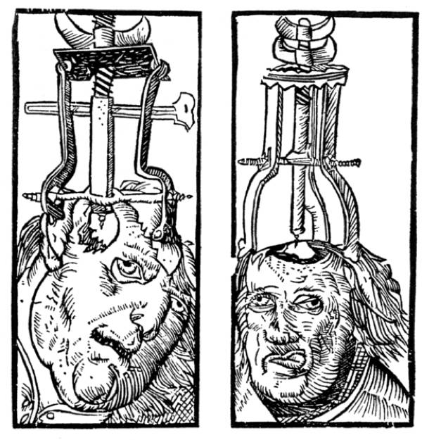 3.) Trepanning