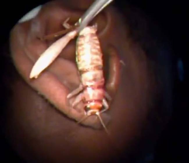 Doctors at the South Zone ENT Research Centre in Villupuram, Tamil Nadu, India, used tweezers to pull the cricket out of the man's ear. Oh, and they caught it all in tape. 