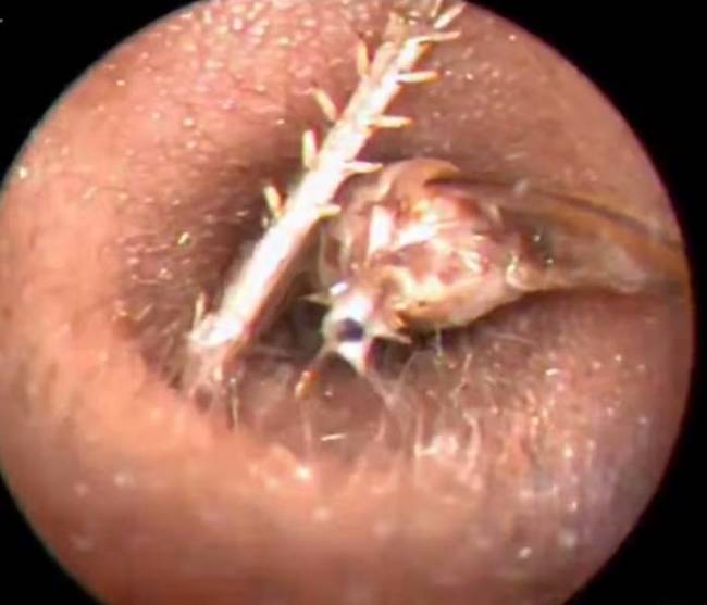 It turns out a massive cricket made its way into the man's ear canal. This is the stuff of nightmares.