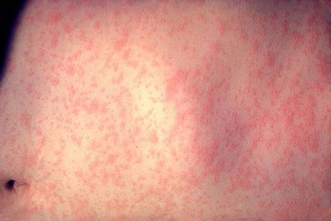 4.) Measles.