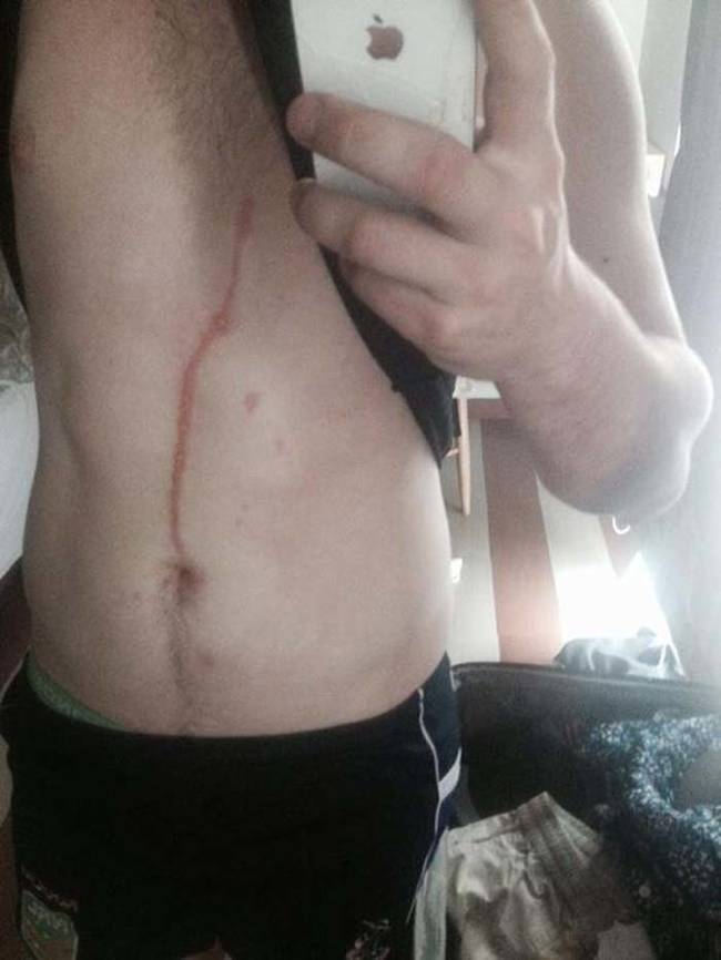He woke up one morning to find a red scratch arching up his belly. “It was like someone had scratched me with a knife,” he said. After two trips to the hospital in almost as many hours, doctors discovered that the red line was the trail of a small tropical spider burrowing its way up his body. Yikes!