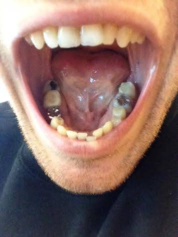 3.) Cavities.