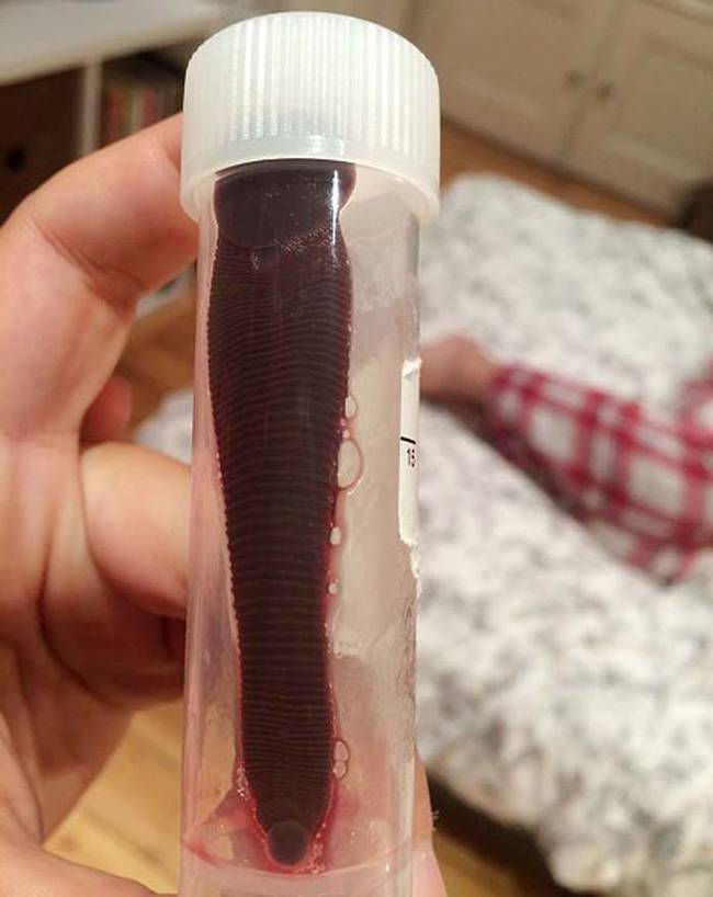 A humongous leech that a Scottish backpacker found dangling out of her nose one day.