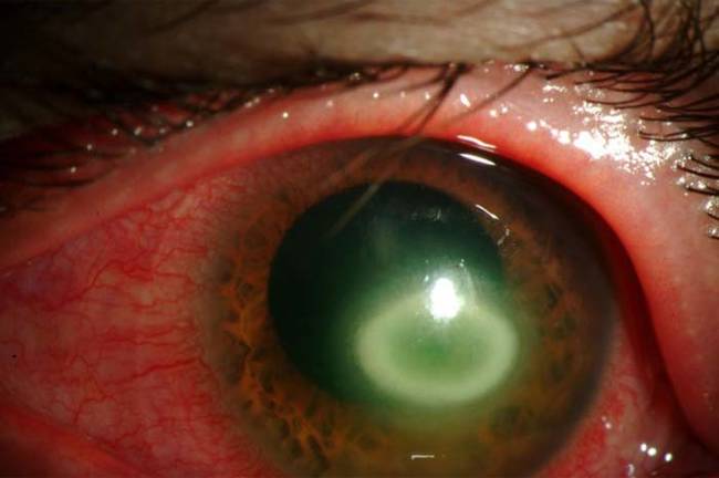 Kao's eyes now look like this and she is completely blind. Acanthamoebic keratitis typically causes some pain and redness, but not enough for most people to seek medical attention.