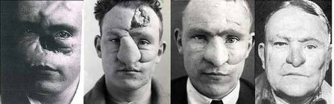 Many consider Gillies to be the father of plastic surgery. Many of the techniques he and his team developed were used for many years. In 1930 he was knighted for his work.