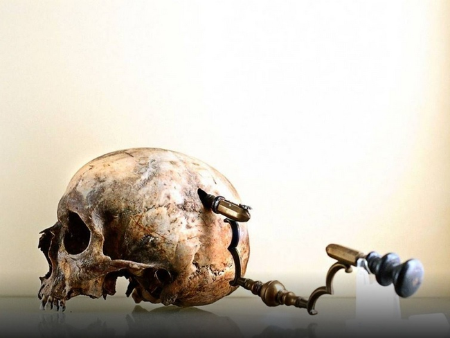 2.) Trepanning: Here the doctor would drill a giant hole in the patient's head for this was believed to cure epilepsy and other mental disorders. But you know, it would also cause create the symptoms of having a giant hole in your brain, so...