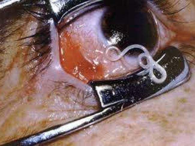 6.) A man in India made the unfortunate realization that a 19 centimeter worm was living inside of his eyeball.