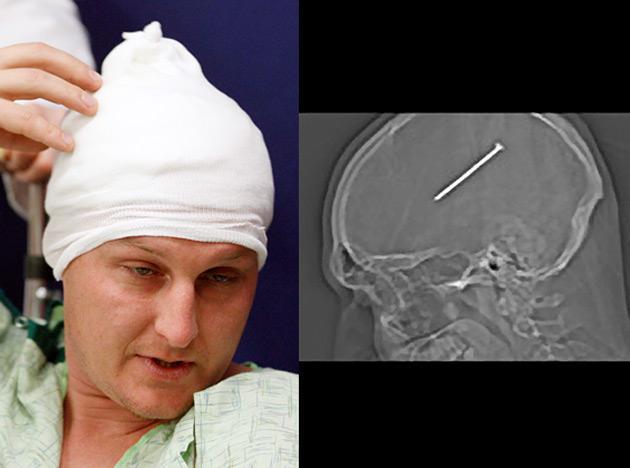 3.) There's always time for a selfie, even when you accidentally shoot a nail into your brain.