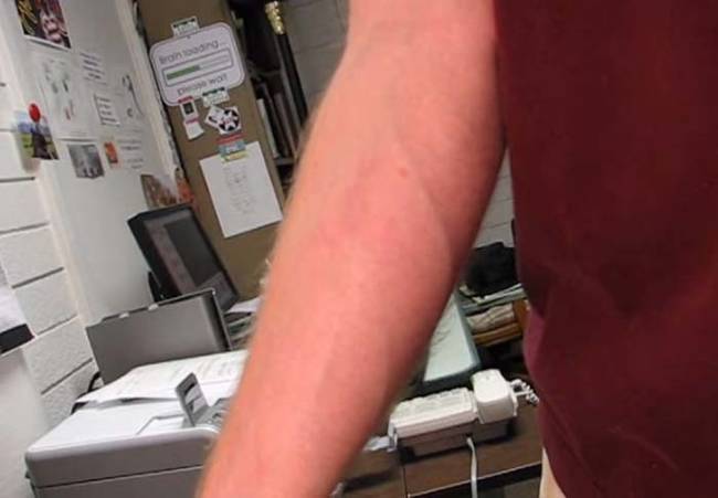 The marks from the "bedbug tattoo gun," are only temporary. Here is Camper showing off the spot where his tattoo used to be about two weeks after administering it.