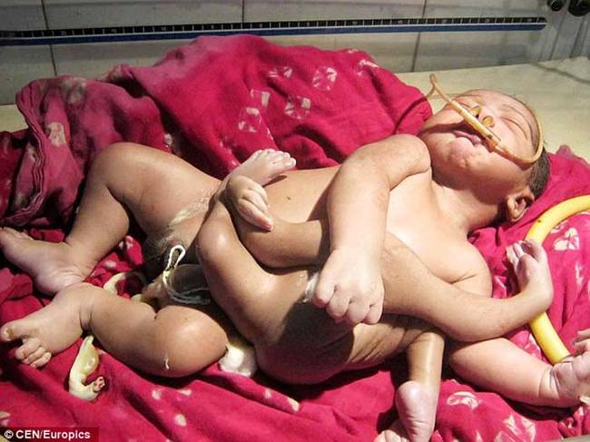 Here is the "God Baby." Doctors believe his extra limbs are the result of a twin that did not develop properly in the womb.