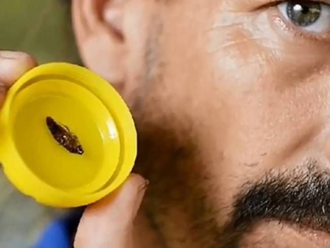 1.) After waking up with an earache, this Australian man discovered a cockroach crammed in his ear.