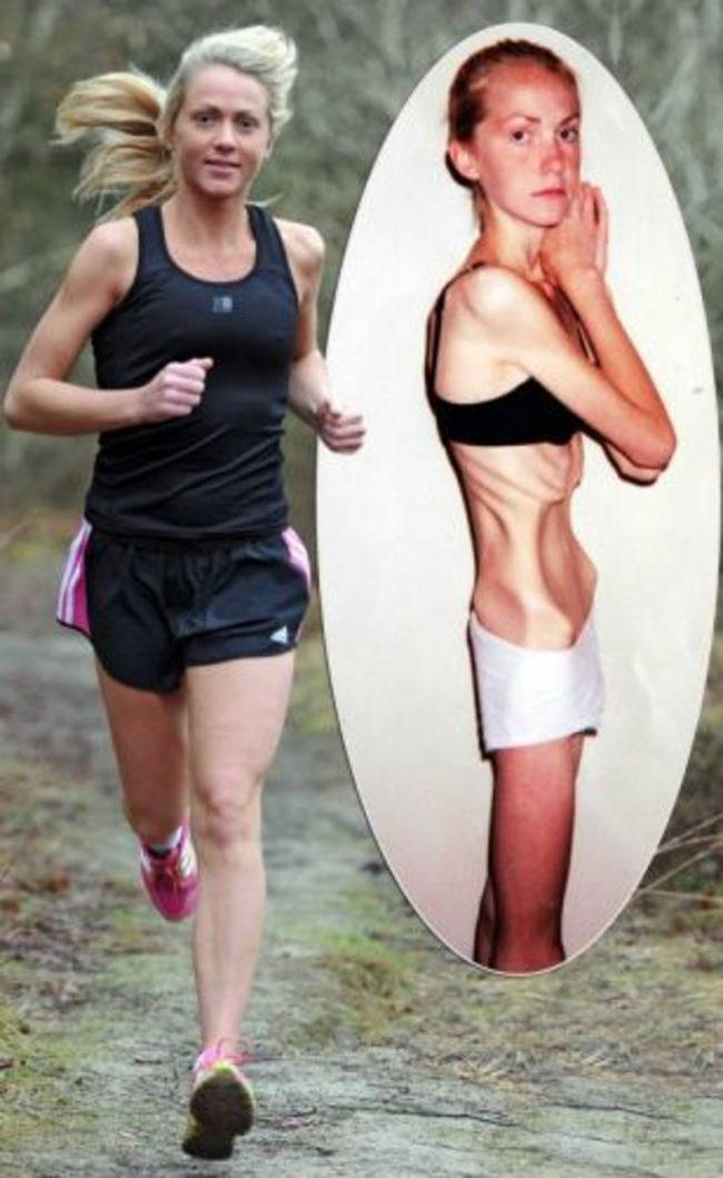 Harriet spent years battling anorexia, and at one point was down to only 70 lbs. When she was told how dangerously close to death she put herself, she worked toward recovery. Now, she stays healthy as an avid runner.