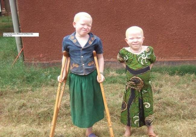 Albino children are often the victim as they are easy to apprehend. Witch doctors also they that their innocence increases the value of the limbs.