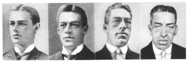 Rainer continued to grow for the remainder of his life, but was plagued by numerous health problems. Eventually, the curvature of his spine become so bad that he was confined to his bed. Rainer also became blind in his right eye, and suffered hearing loss in his left ear.