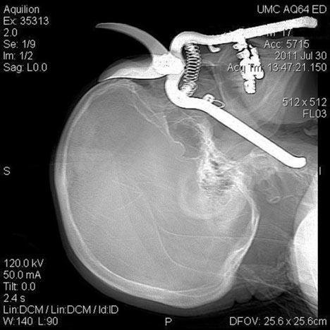 4.) This man accidentally impaled himself in the eye with his pruning shears.