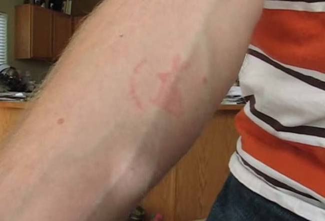 This is how Camper's arm looked about two hours after the bites.