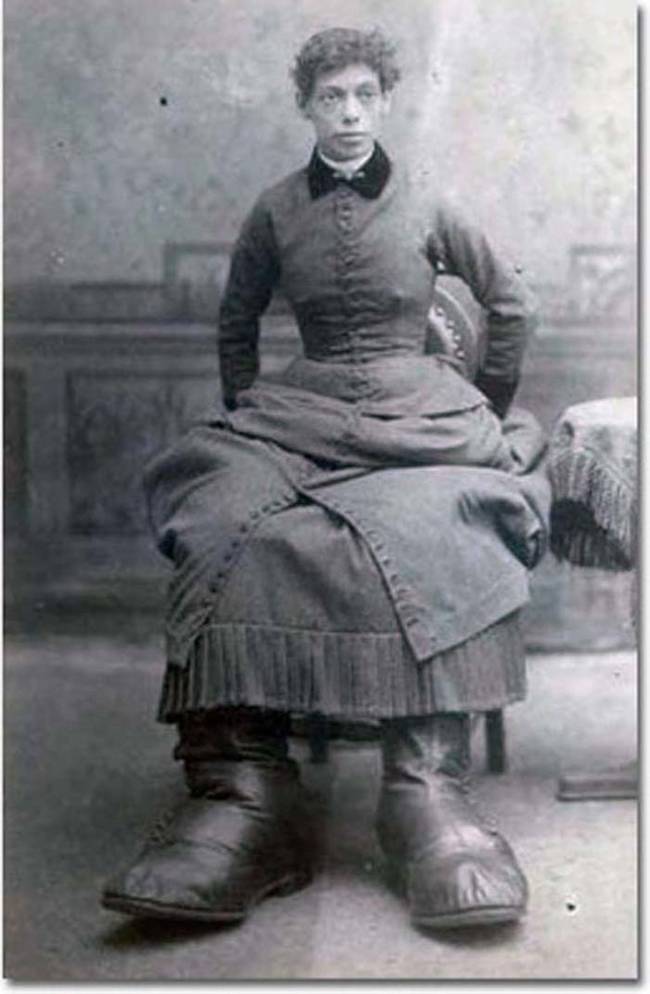 Fannie had a condition known as Milroy Disease, which caused her feet to grow to an abnormally large size. At their biggest, her feet were 17 inches long.