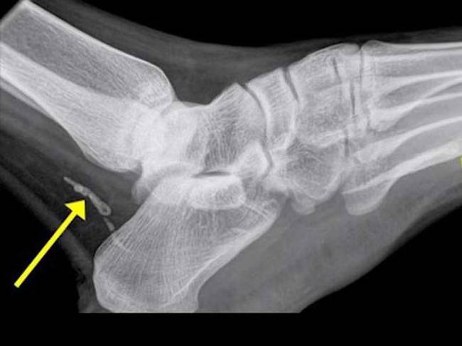 The man is an African immigrant who came to Australia from Sudan about 4 years ago. He had been complaining about foot pain for about a year. Initially doctors thought it was an infection, but they took an x-ray anyway. That's when they found this.