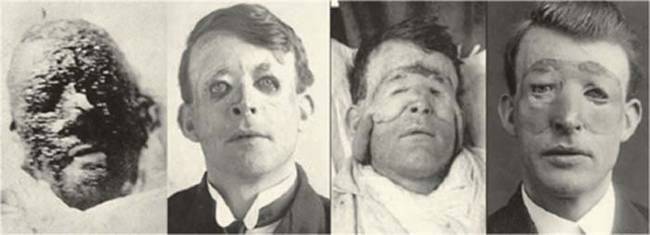 During World War II he worked with the British government to establish plastic surgery units across the country.