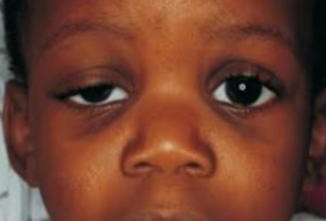 5.) Aarskoge Syndrome: Wide set and 'droopy' eyes at an early age. It can also cause a child's hand to only have a single crease in the palm of the hand.