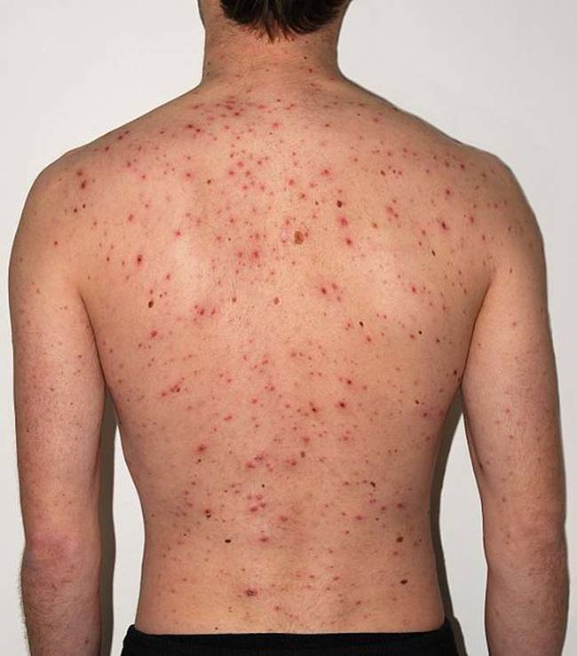 6.) Chicken Pox.