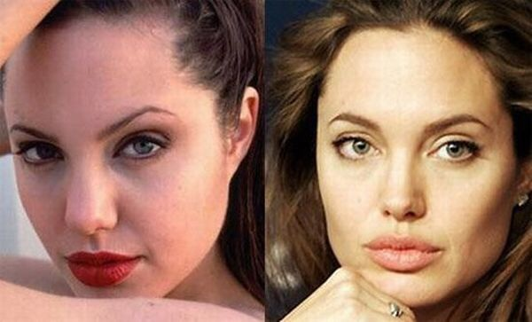 20.) Angelina Jolie--yet another example of how surgery isn't necessary.