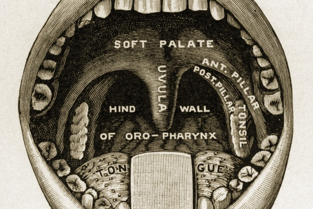 Tonsil stones