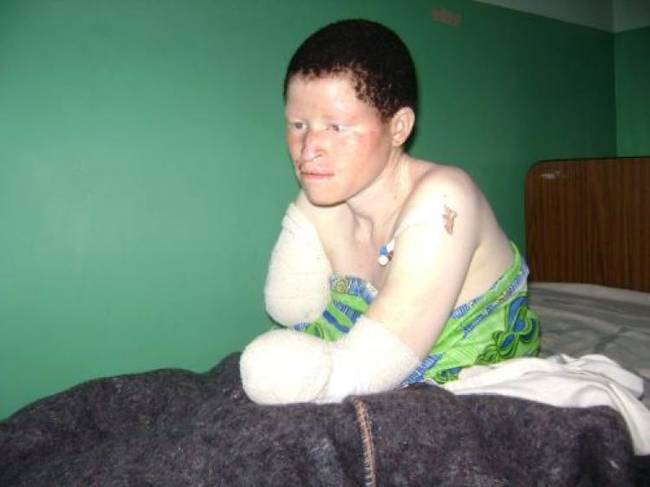 Albino citizens aren't in danger of JUST losing their limbs, though. Black markets in Tanzania have been known to sell albino genitals, bits of skin, ears, tongues, eyes, and sometimes just the whole head.