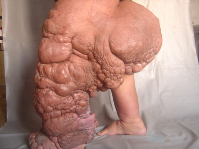 1.) Elephantiasis: Extreme swelling of the skin that also produces and large, wart-like nodules.