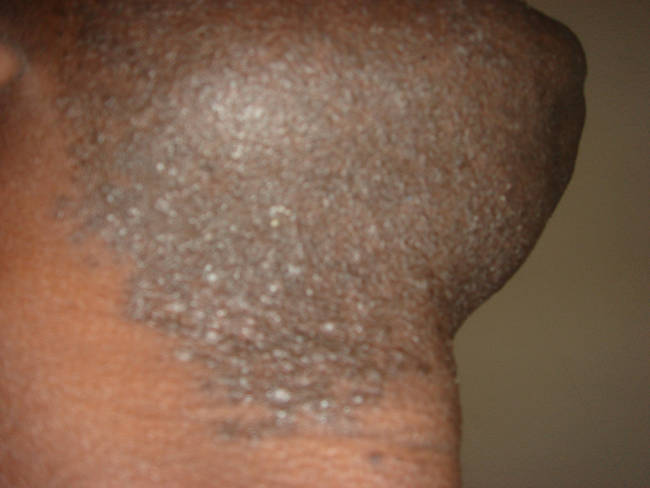 Ingrown hairs can be very painful, and occur when a hair gets stuck inside of the pore it is supposed to exit.