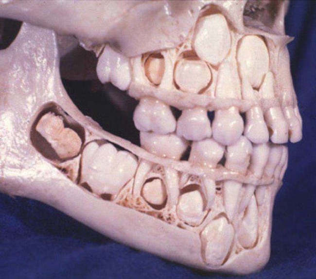 14.) What the human jaw looks like before losing baby teeth.