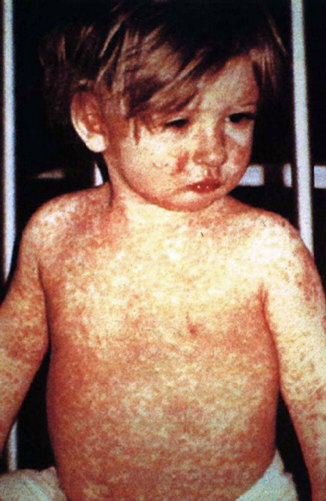 3.) Measles.