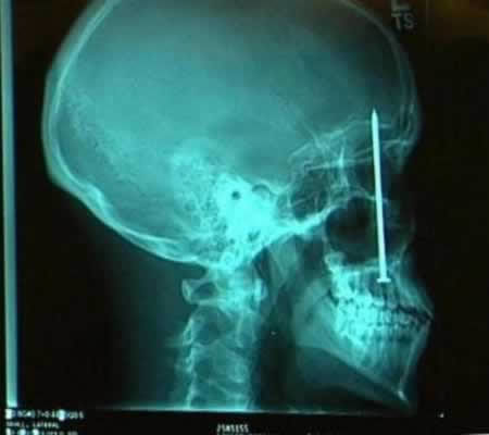 1.) A construction worker unknowingly embedded a four-inch nail in his skull.