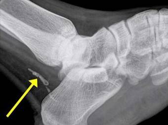 This Man Thought He Had An Infected Foot, The Truth Is Much More Shocking