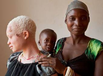 What Witchdoctors Are Doing To Albino Children Is Shocking Beyond Belief