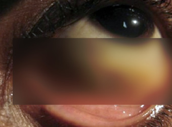 When You See What They Found In This Guy’s Eye, You’ll Never Feel Safe Again