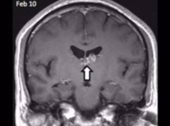 This Man Had No Idea About The Tapeworm Living Inside His Brain For 4 Years